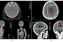 河北一洲肿瘤医院成功完成罕见儿童脑瘤治疗，成果论文登上国际知名期刊