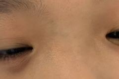 八岁儿童眼睛“鼓大包”永春爱尔眼科提醒：要注意日常用眼卫生