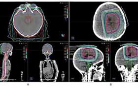 河北一洲肿瘤医院成功完成罕见儿童脑瘤治疗，成果论文登上国际知名期刊