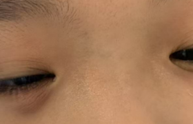 八岁儿童眼睛“鼓大包”永春爱尔眼科提醒：要注意日常用眼卫生