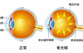 跨越无声与黑暗：永春爱尔眼科助83岁聋哑老人重寻光明